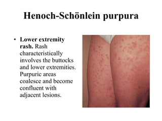Henoch-Schönlein purpura Lower extremity rash.  Rash characteristically involves the buttocks and lower extremities. Purpuric areas coalesce and become confluent with adjacent lesions.  