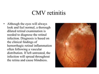 CMV retinitis  Although the eyes will always look and feel normal, a thorough dilated retinal examination is needed to diagnose the retinal infection. Diagnosis is based on the clinical findings of hemorrhagic retinal inflammation often following a vascular distribution. If left untreated, the infection will spread throughout the retina and cause blindness.  