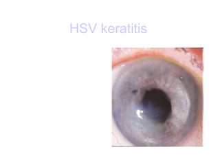 HSV  keratitis   