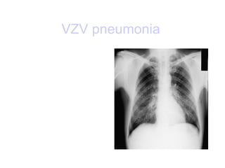 VZV pneumonia   
