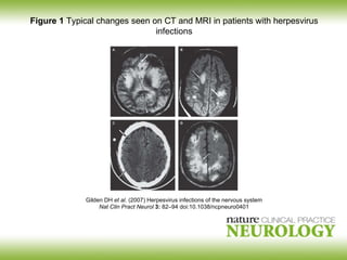 Gilden DH  et al.  (2007) Herpesvirus infections of the nervous system Nat Clin Pract  Neurol   3:  82 – 94 doi:10.1038/ncpneuro0401 Figure 1  Typical changes seen on CT and MRI in patients with herpesvirus infections 
