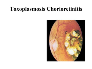 Toxoplasmosis Chorioretinitis 