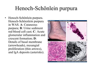 Henoch-Schönlein purpura Henoch-Schönlein purpura. Henoch-Schöenlein purpura in WAS.  A : Cutaneous purpura;  B : Urine sediment red blood cell cast;  C : Acute glomerular inflammation and crescent formation;  D : Details of basal membrane (arrowheads), mesangial proliferation (thin arrows), and IgA deposits (asterisks).  