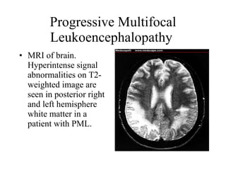 Progressive Multifocal Leukoencephalopathy  MRI of brain. Hyperintense signal abnormalities on T2-weighted image are seen in posterior right and left hemisphere white matter in a patient with PML.  