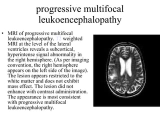progressive multifocal leukoencephalopathy MRI of progressive multifocal leukoencephalopathy.  T2  weighted MRI at the level of the lateral ventricles reveals a subcortical, hyperintense signal abnormality in the right hemisphere. (As per imaging convention, the right hemisphere appears on the left side of the image). The lesion appears restricted to the white matter and does not exhibit mass effect. The lesion did not enhance with contrast administration. The appearance is most consistent with progressive multifocal leukoencephalopathy.  