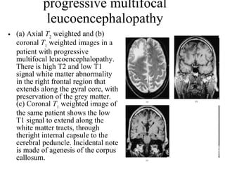 progressive multifocal leucoencephalopathy (a) Axial  T 2  weighted and (b) coronal  T 1  weighted images in a patient with progressive multifocal leucoencephalopathy. There is high T2 and low T1 signal white matter abnormality in the right frontal region that extends along the gyral core, with preservation of the grey matter. (c) Coronal  T 1  weighted image of the same patient shows the low T1 signal to extend along the white matter tracts, through theright internal capsule to the cerebral peduncle. Incidental note is made of agenesis of the corpus callosum.  
