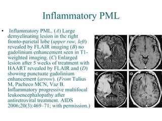 Inflammatory PML   Inflammatory PML. ( A ) Large demyelinating lesion in the right fronto-parietal lobe ( upper row, left ) revealed by FLAIR imaging ( B ) no gadolinium enhancement seen in T1-weighted imaging. ( C ) Enlarged lesion after 5 weeks of treatment with HAART revealed by FLAIR and ( D ) showing punctuate gadolinium enhancement ( arrow ). ( From  Tulius M, Pacheco MCN, Vaz B. Inflammatory progressive multifocal leukoencephalopathy after antiretroviral treatment. AIDS 2006;20(3):469–71; with permission.)   
