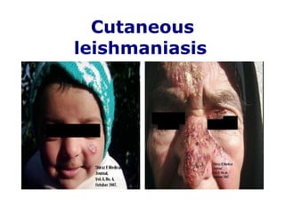 Cutaneous leishmaniasis   