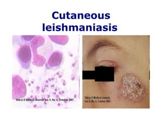 Cutaneous leishmaniasis   