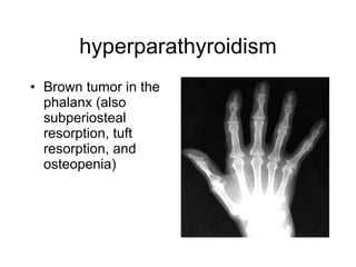 hyperparathyroidism Brown tumor in the phalanx (also subperiosteal resorption, tuft resorption, and osteopenia)   