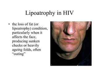 Lipoatrophy in HIV the loss of fat (or lipoatrophy) condition, particularly when it affects the face, producing sunken cheeks or heavily ageing folds, often “outing”  