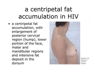 a centripetal fat accumulation in HIV a centripetal fat accumulation, with enlargement of posterior cervical region (hump), lower portion of the face, malar and mandibular regions and intensive fat deposit in the dorsum   