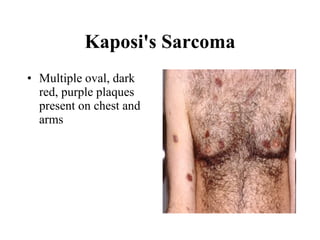 Kaposi's Sarcoma Multiple oval, dark red, purple plaques present on chest and arms  