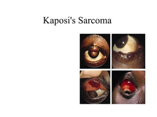 Kaposi's Sarcoma  