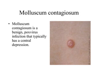 Molluscum contagiosum Molluscum contagiosum is a benign, poxvirus infection that typically has a central depression.  