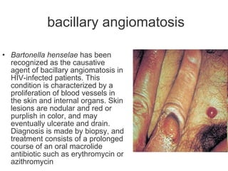 bacillary angiomatosis Bartonella henselae  has been recognized as the causative agent of bacillary angiomatosis in HIV-infected patients. This condition is characterized by a proliferation of blood vessels in the skin and internal organs. Skin lesions are nodular and red or purplish in color, and may eventually ulcerate and drain. Diagnosis is made by biopsy, and treatment consists of a prolonged course of an oral macrolide antibiotic such as erythromycin or azithromycin   