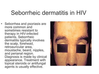 Seborrheic dermatitis in HIV  Seborrhea and psoriasis are more common and sometimes resistant to therapy in HIV-infected patients. Seborrheic dermatitis typically involves the scalp, forehead, retroauricular area, moustache, beard, nipples, and perianal region. Diagnosis is made by clinical appearance. Treatment with topical steroids or antifungal agents is usually effective.   