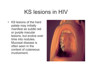 KS lesions in HIV KS lesions of the hard palate may initially manifest as subtle red or purple macular lesions, but evolve over time into nodules. Mucosal disease is often seen in the context of cutaneous involvement.   