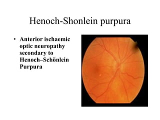 Henoch-Shonlein purpura Anterior ischaemic optic neuropathy secondary to Henoch–Schönlein Purpura 