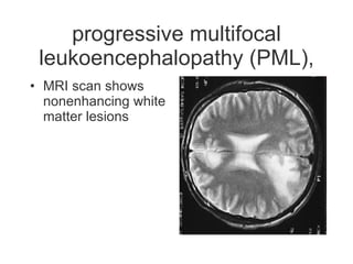 progressive multifocal leukoencephalopathy (PML), MRI scan shows nonenhancing white matter lesions 