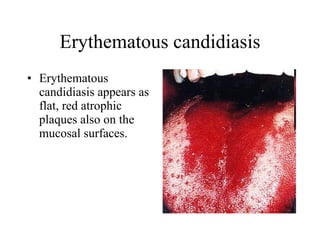 Erythematous candidiasis Erythematous candidiasis appears as flat, red atrophic plaques also on the mucosal surfaces.  