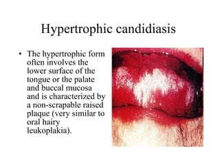 Hypertrophic candidiasis  The hypertrophic form often involves the lower surface of the tongue or the palate and buccal mucosa and is characterized by a non-scrapable raised plaque (very similar to oral hairy leukoplakia).  