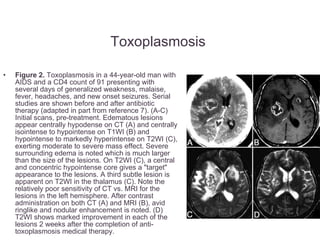 Toxoplasmosis  Figure 2.  Toxoplasmosis in a 44-year-old man with AIDS and a CD4 count of 91 presenting with several days of generalized weakness, malaise, fever, headaches, and new onset seizures. Serial studies are shown before and after antibiotic therapy (adapted in part from reference 7). (A-C) Initial scans, pre-treatment. Edematous lesions appear centrally hypodense on CT (A) and centrally isointense to hypointense on T1WI (B) and hypointense to markedly hyperintense on T2WI (C), exerting moderate to severe mass effect. Severe surrounding edema is noted which is much larger than the size of the lesions. On T2WI (C), a central and concentric hypointense core gives a "target" appearance to the lesions. A third subtle lesion is apparent on T2WI in the thalamus (C). Note the relatively poor sensitivity of CT vs. MRI for the lesions in the left hemisphere. After contrast administration on both CT (A) and MRI (B), avid ringlike and nodular enhancement is noted. (D) T2WI shows marked improvement in each of the lesions 2 weeks after the completion of anti-toxoplasmosis medical therapy.  