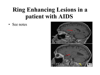 Ring Enhancing Lesions in a patient with AIDS   See notes 
