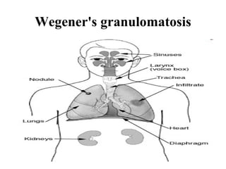 Wegener's granulomatosis 