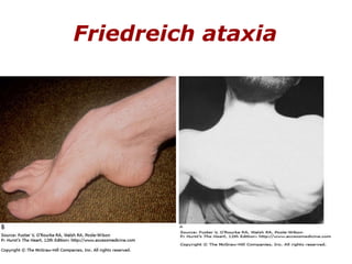 Friedreich ataxia   