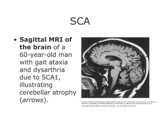 SCA Sagittal MRI of the brain  of a 60-year-old man with gait ataxia and dysarthria due to SCA1, illustrating cerebellar atrophy ( arrows ). 