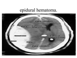 epidural hematoma. 