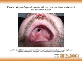 Aries PM  et al.  (2006) A case of destructive Wegener’s granulomatosis complicated by cytomegalovirus infection  Nat Clin Pract  Rheumatol   2:   511 – 515  doi:10.1038/ ncprheum0269 Figure 1  Wegener's granulomatosis with ear, nose and throat involvement and palatal destruction 