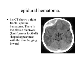epidural hematoma. his CT shows a right frontal epidural hematoma. There is the classic biconvex (lentiform or football) shaped appearance with the dura bulging inward.  
