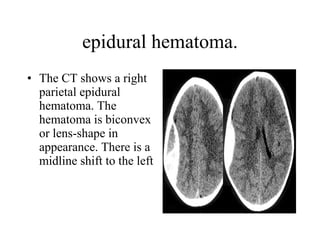 epidural hematoma. The CT shows a right parietal epidural hematoma. The hematoma is biconvex or lens-shape in appearance. There is a midline shift to the left  