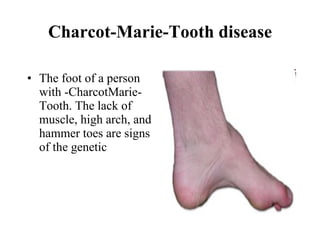 Charcot-Marie-Tooth disease The foot of a person with -CharcotMarie-Tooth. The lack of muscle, high arch, and hammer toes are signs of the genetic  