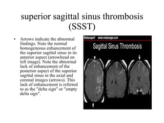 superior sagittal sinus thrombosis (SSST) Arrows indicate the abnormal findings. Note the normal homogeneous enhancement of the superior sagittal sinus in its anterior aspect (arrowhead on left image). Note the abnormal lack of enhancement of the posterior aspect of the superior sagittal sinus in the axial and coronal images (arrows). This lack of enhancement is referred to as the "delta sign" or "empty delta sign".  
