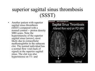 superior sagittal sinus thrombosis (SSST) Another patient with superior sagittal sinus thrombosis (SSST) compared with a normal control -- proton density MRI scans. Note the hyperintensity of the superior sagittal sinus (arrow), most likely due to extracellular methemoglobin in the subacute clot. The normal individual has a normal flow void (lack of signal) in the superior sagittal sinus. The clot was also hyperintense on T1- and  
