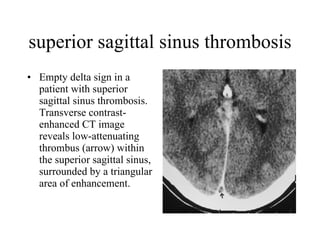 superior sagittal sinus thrombosis Empty delta sign in a patient with superior sagittal sinus thrombosis. Transverse contrast-enhanced CT image reveals low-attenuating thrombus (arrow) within the superior sagittal sinus, surrounded by a triangular area of enhancement.  