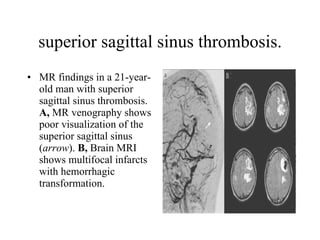 superior sagittal sinus thrombosis. MR findings in a 21-year-old man with superior sagittal sinus thrombosis.  A,  MR venography shows poor visualization of the superior sagittal sinus ( arrow ).  B,  Brain MRI shows multifocal infarcts with hemorrhagic transformation. 