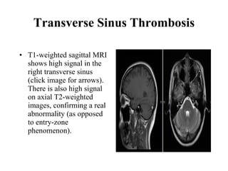 Transverse Sinus Thrombosis T1-weighted sagittal MRI shows high signal in the right transverse sinus (click image for arrows). There is also high signal on axial T2-weighted images, confirming a real abnormality (as opposed to entry-zone phenomenon).  