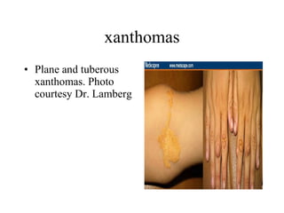 xanthomas Plane and tuberous xanthomas. Photo courtesy Dr. Lamberg  