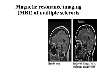 Magnetic resonance imaging (MRI) of multiple sclerosis 