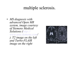 multiple sclerosis. MS diagnosis with advanced Open MR system, image courtesy of Siemens Medical Solutions ( http:// www.usa.siemens.com / ). T2 image on the left and Turbo-FLAIR image on the right   