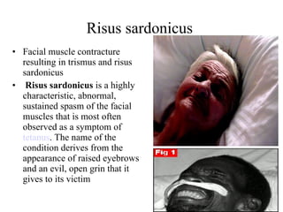 Risus sardonicus  Facial muscle contracture resulting in trismus and risus sardonicus Risus sardonicus  is a highly characteristic, abnormal, sustained spasm of the facial muscles that is most often observed as a symptom of  tetanus . The name of the condition derives from the appearance of raised eyebrows and an evil, open grin that it gives to its victim  