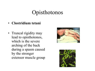 Opisthotonos Clostridium tetani Truncal rigidity may lead to opisthotonos, which is the severe arching of the back   during a spasm caused by the stronger extensor muscle group  