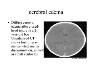 cerebral edema Diffuse cerebral edema after closed-head injury in a 2-year-old boy. Unenhanced CT shows loss of gray matter/white matter discrimination, as well as small ventricles.  