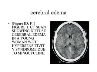 cerebral edema [Figure ID: F1] FIGURE 1. CT SCAN SHOWING DIFFUSE CEREBRAL EDEMA IN A YOUNG WOMAN WITH HYPERSENSITIVITY SYNDROME DUE TO MINOCYCLINE. 