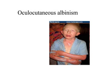 Oculocutaneous albinism  