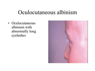 Oculocutaneous albinism Oculocutaneous albinism with abnormally long eyelashes  